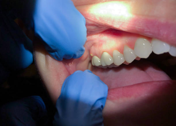 Best Emergency Treatment for Dental Infections or Abscesses in Washington, IA