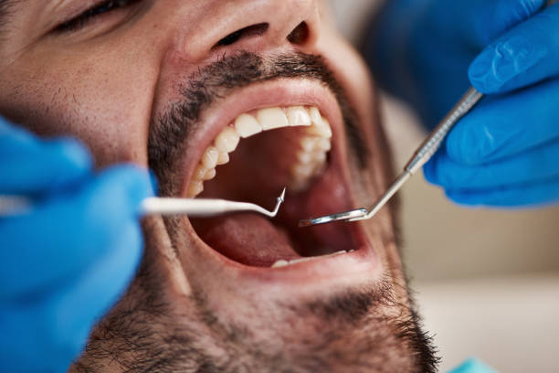 Best Emergency Dental Care for Broken or Chipped Teeth in Washington, IA